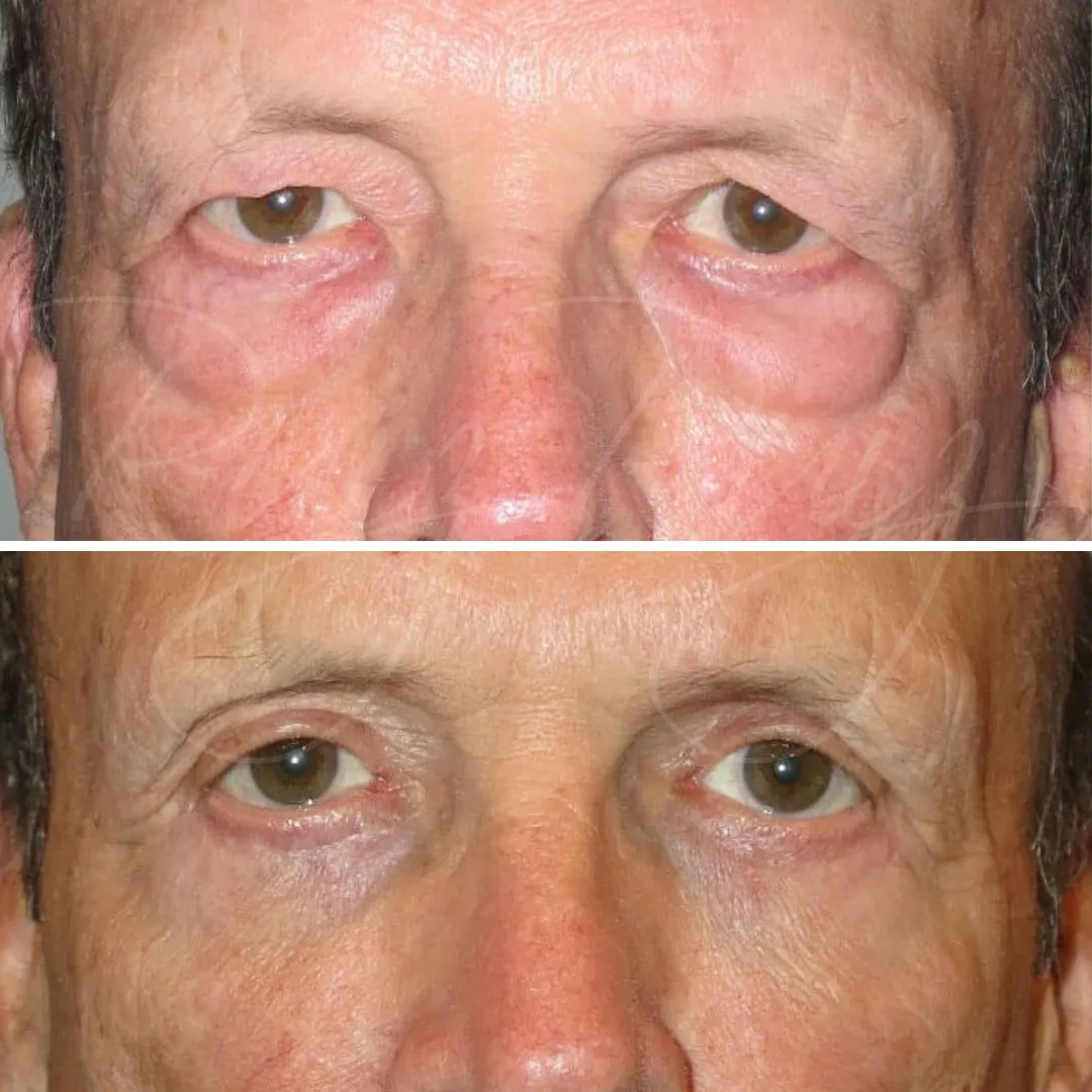 Antes y después de Blefaroplastia superior e inferior en hombre, enfocando en la reducción de bolsas y el exceso de piel en párpados.