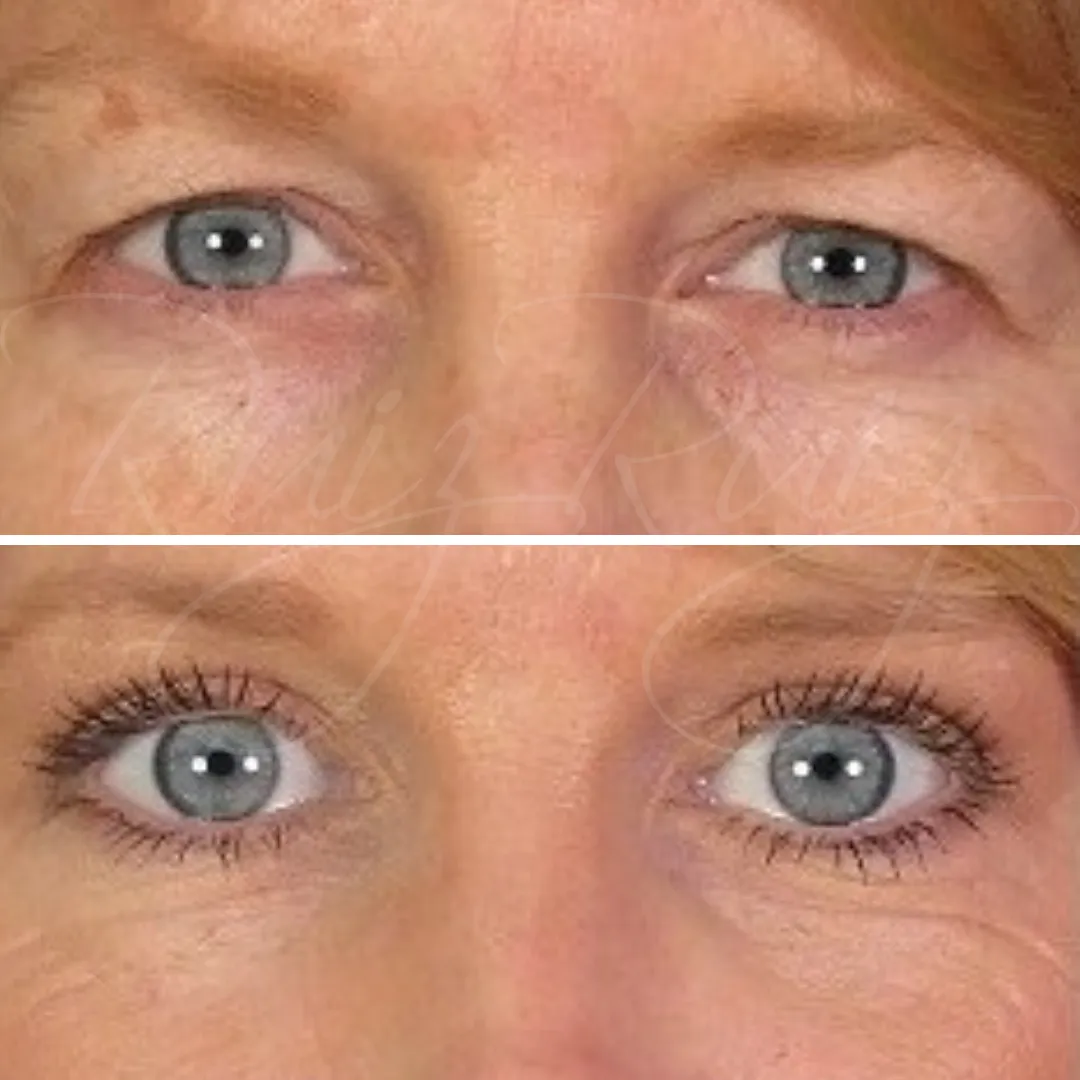 Antes y después de Blefaroplastia superior e inferior en mujer, mostrando el rejuvenecimiento de la mirada y la elevación del párpado.