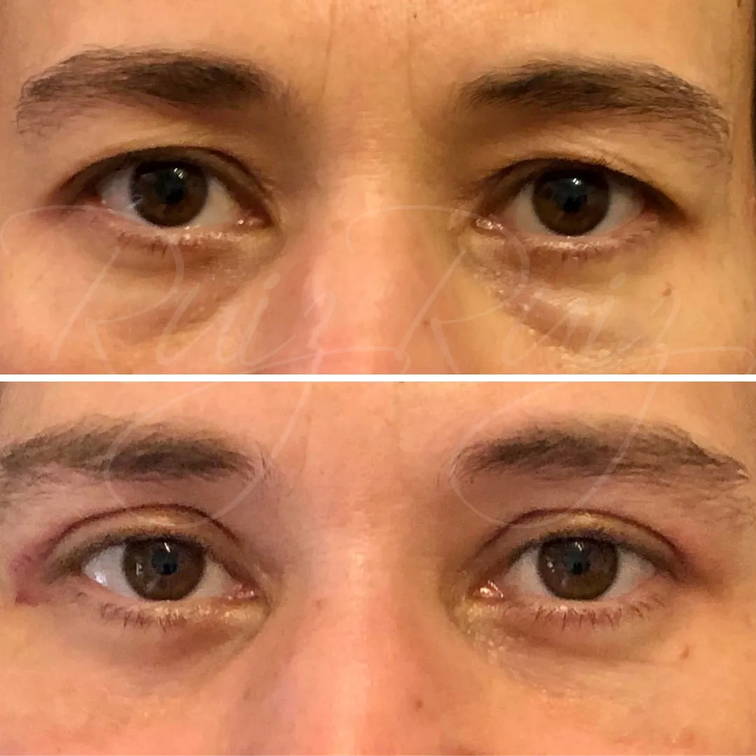 Antes y después de Blefaroplastia en un hombre joven, enfocado en corregir bolsas leves y exceso de piel en el párpado superior.
