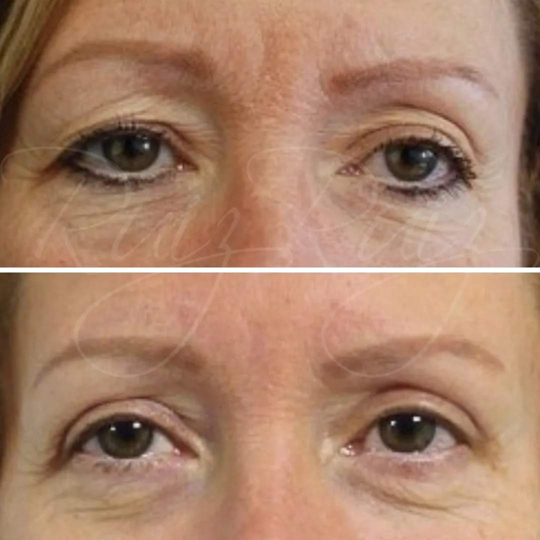 Antes y después de Blefaroplastia en mujer, resaltando la corrección de la flacidez del párpado superior y las patas de gallo.