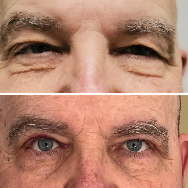 Antes y después de Blefaroplastia superior en hombre de edad avanzada, mostrando la mejora en la visión y el aspecto cansado.