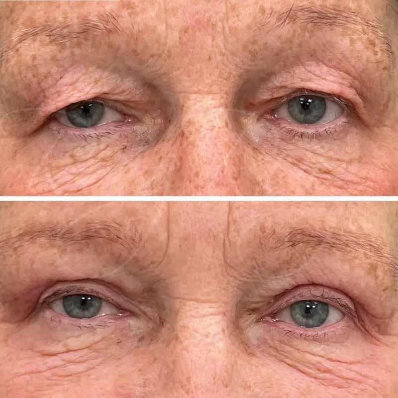 Antes y después de Blefaroplastia inferior y superior en mujer mayor, con notable reducción de arrugas y piel sobrante.