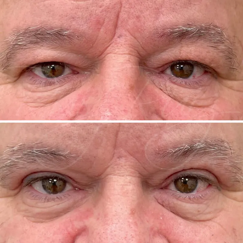 Primer plano de los ojos de un hombre de edad avanzada, con bolsas en los párpados inferiores y arrugas en el entrecejo, pre-tratamiento.