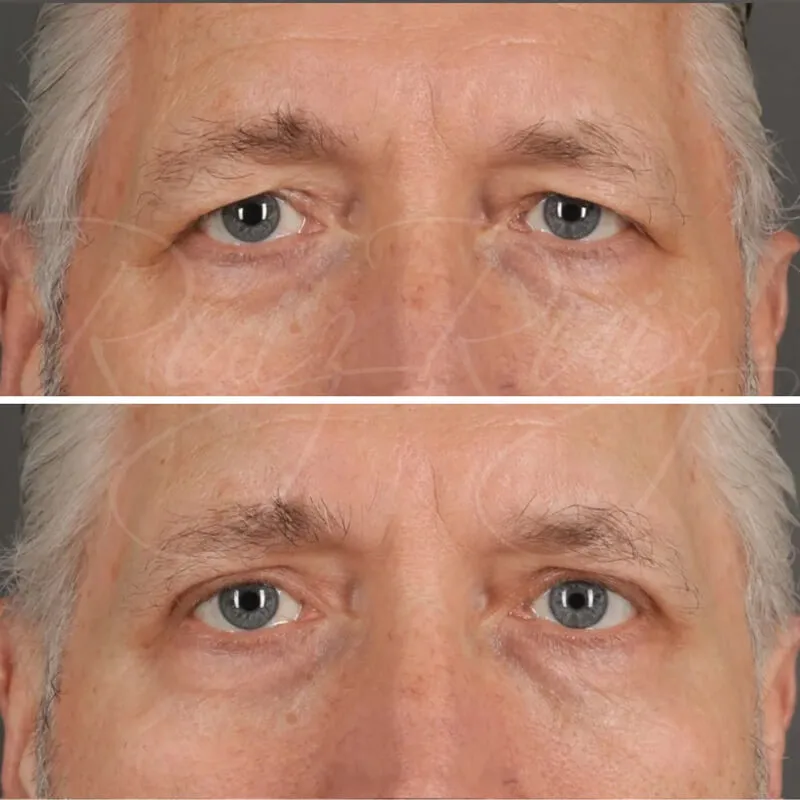 Antes y después de Blefaroplastia superior en hombre mayor, con resultados naturales de párpados más abiertos y estirados.