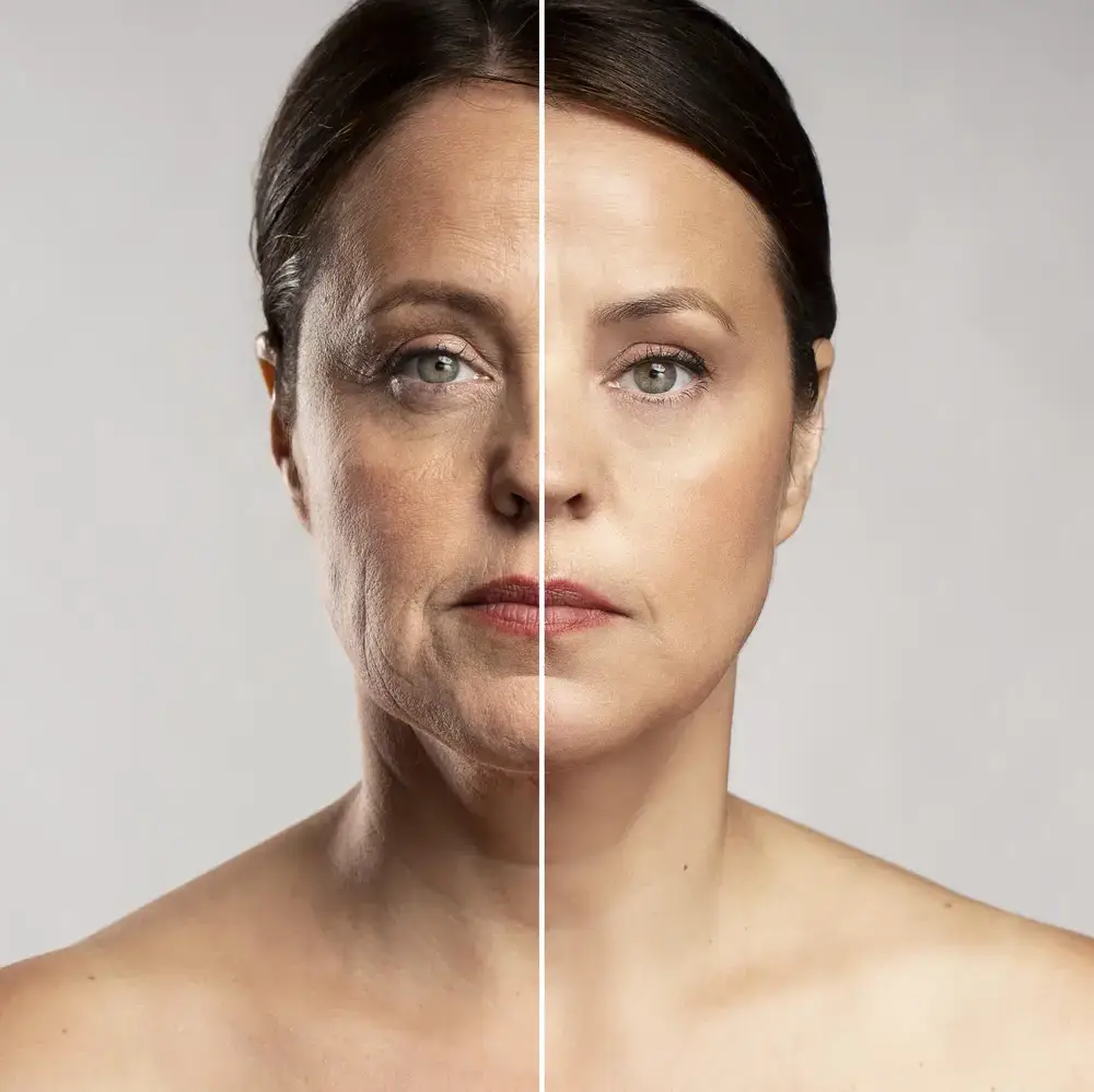 Cara de mujer de mediana edad en la que se aprecia mediante el montaje de dos fotografías el antes y el despuérs de un lifting facial. con resultados naturales completamente visibles.