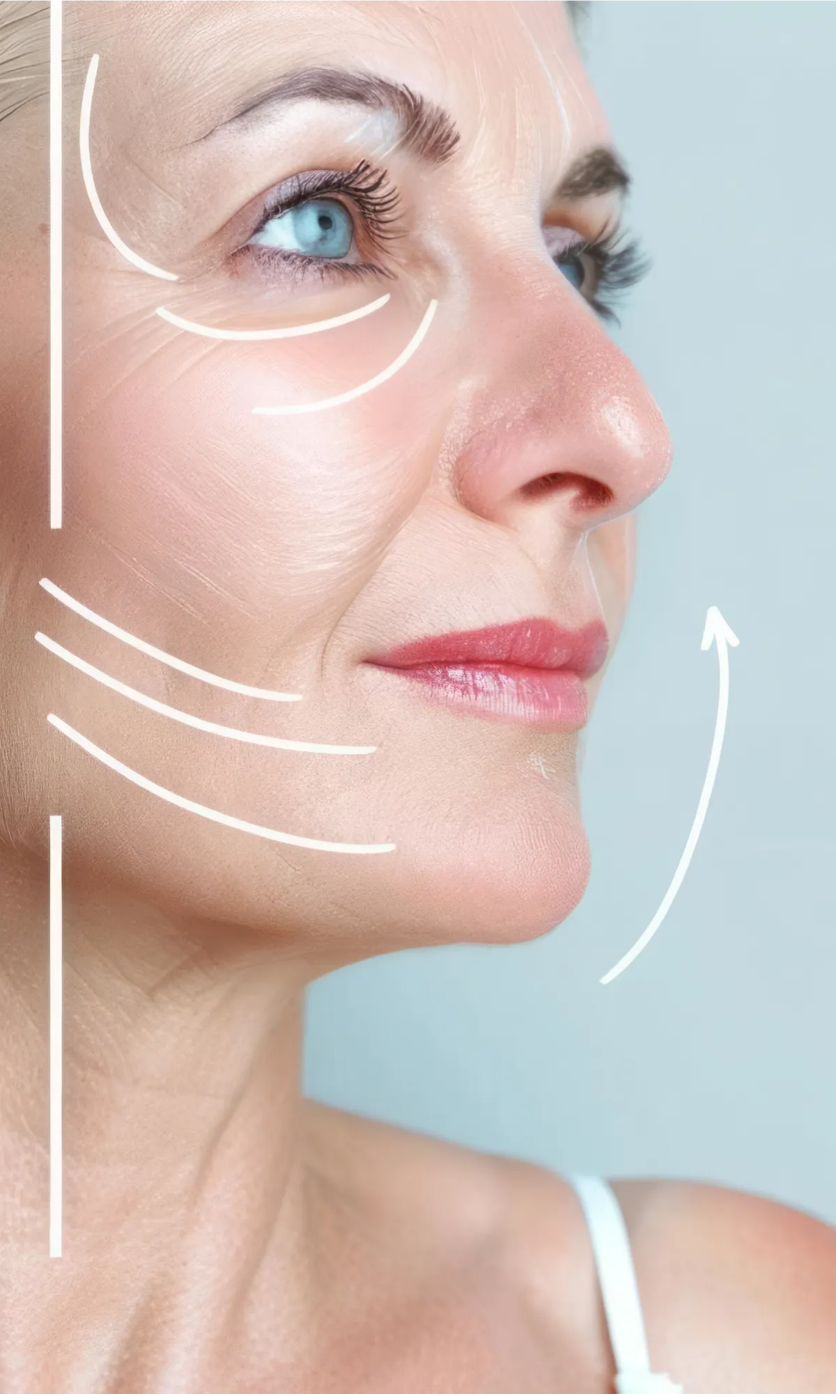 Rostro de una mujer de mediana edad, de perfil, en el que se definen, marcados por líneas blancas sobre la fotografía, los resultados de un lifting facial para levantar y apretar la piel flácida y redefinir el contorno de la cara