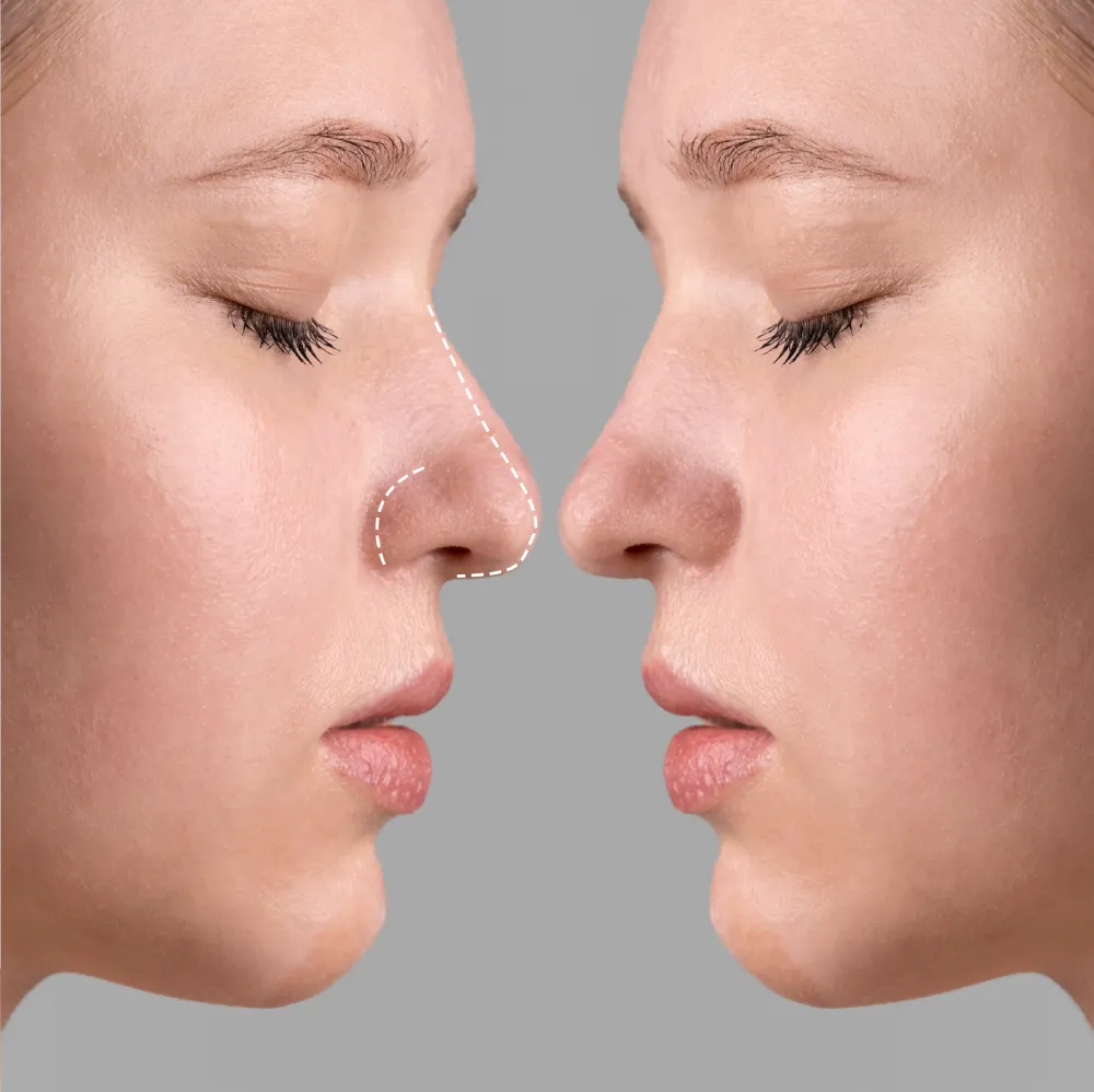 Rostro de perfil de mujer joven en el que se aprecia, mediante el montaje de dos fotografías en espejo, el antes y el después de una rinoplastia con resultados naturales y sutiles.